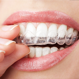 Dental Implants Dentist in Los Angeles